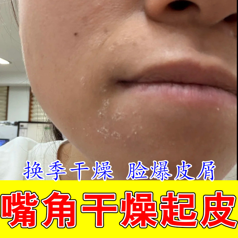 脸干燥起皮泛红屏障修复脸上有碎屑换季爆皮长痒面部皮肤敏感甘油