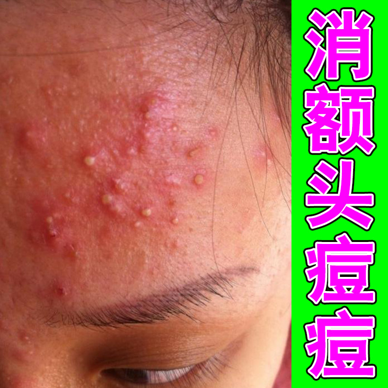 脸上痘毛囊脸上起小疙瘩膏脸上痘痘淋巴腮边痘治脸频