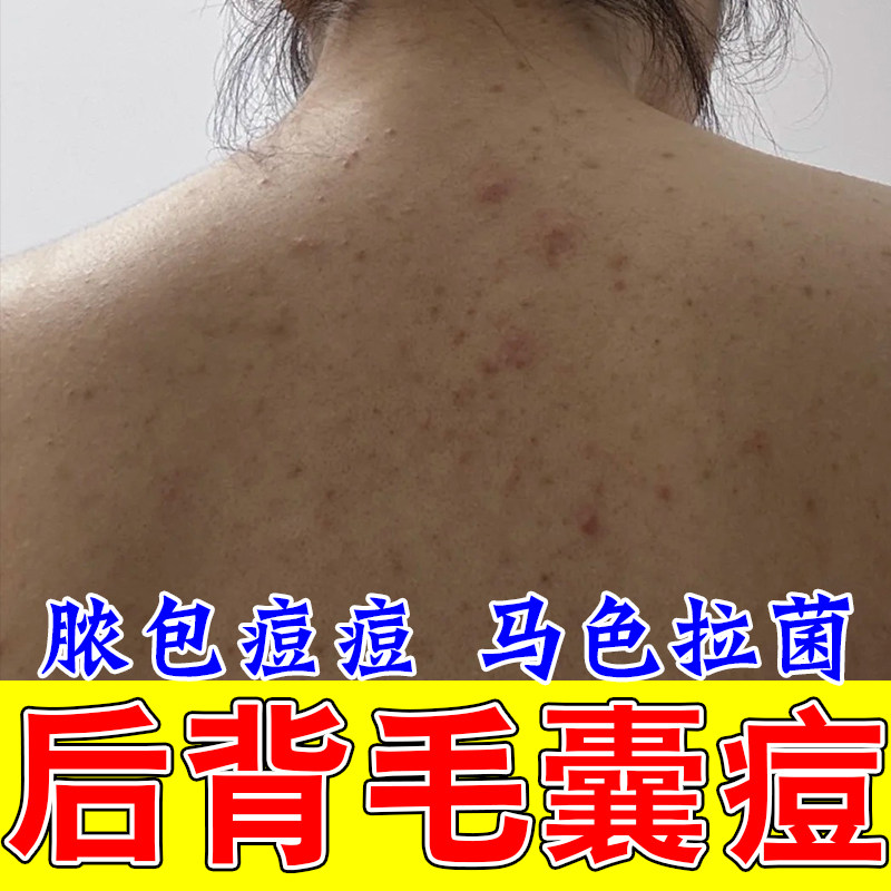 后背长痘毛囊背部起疙瘩红肿毛囊堵塞真菌粗糙痒疙瘩修护植物膏