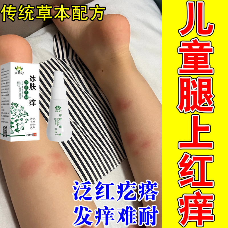 儿童身上起红疙瘩痒腿部蚊虫叮咬皮肤过敏起小红点长痘刺挠痒喷剂
