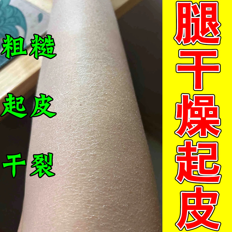 冶腿上干燥起皮小腿皮肤白屑粗糙干裂成人身上掉皮屑干皮甘油