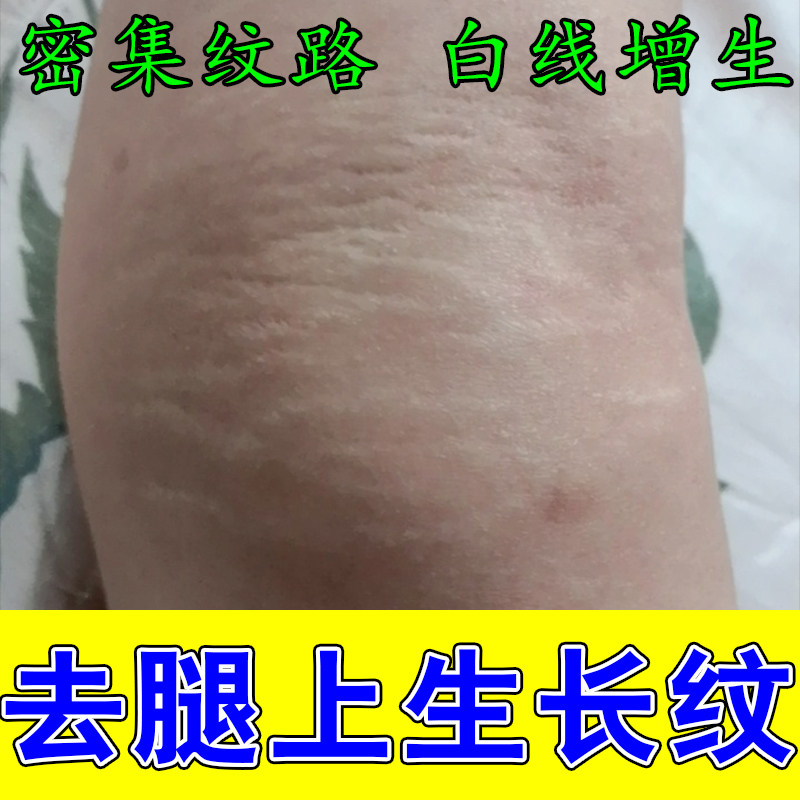肥胖纹修复膏生长纹消身上腿上学生白色淡化纹路淡肥胖纹修复膏