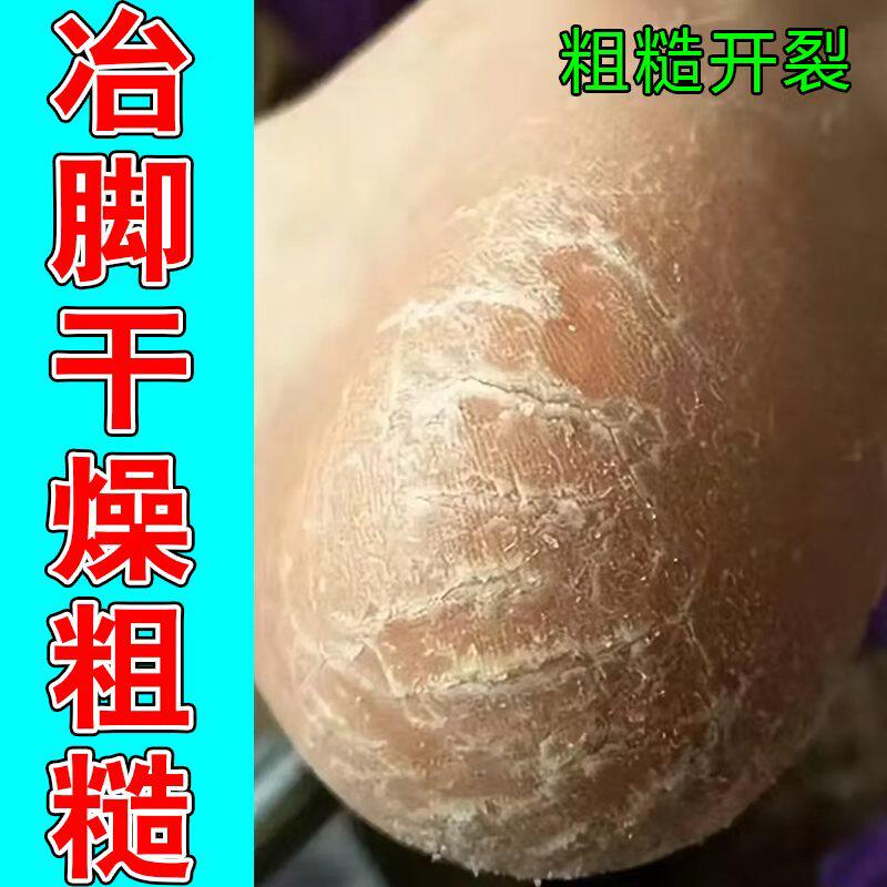 角化粗糙干燥脚底硬皮干裂真菌蜕皮足跟开裂手上起皮爆皮保湿药乳