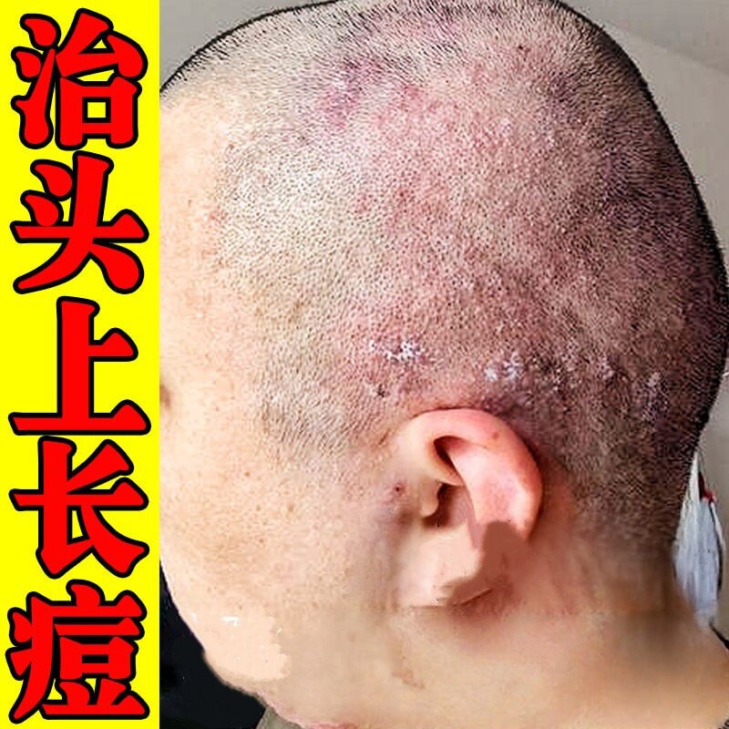 头上长痘毛囊专用头皮起红疙瘩脓包脂溢性皮真菌染专用膏