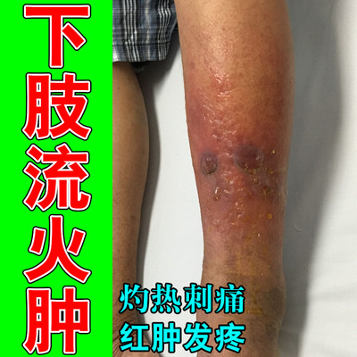 冶小腿红肿消肿泛红大面积痛下肢流火皮肤红肿灼热痒植物修护膏