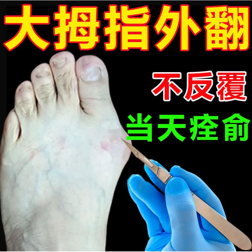 拇指外翻药膏贴大脚骨专用药脚趾重叠膏克星突出矫正器治疗拇囊炎