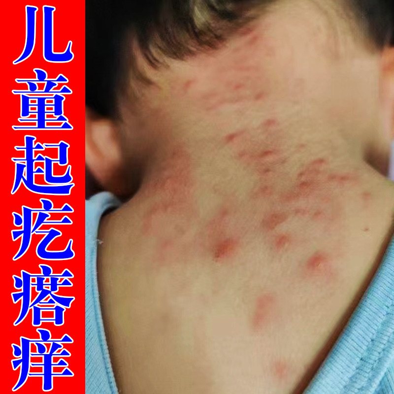 治身上起红疙瘩痒夏天小孩皮肤起红点干燥痒消包专用膏