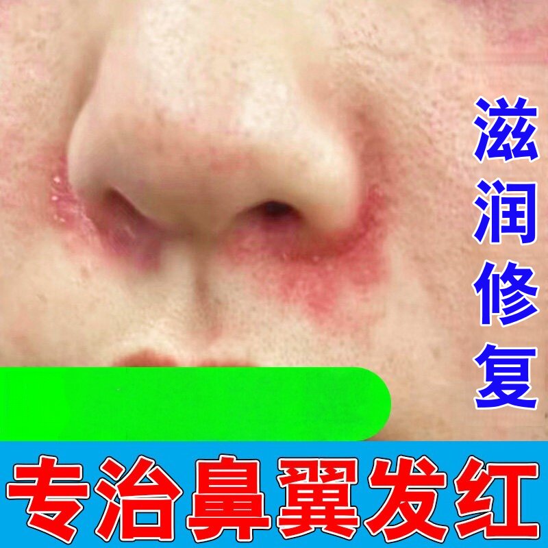 鼻子两侧发红脱皮鼻翼两边泛红干燥起皮脂溢性皮焱面部鼻子两侧红