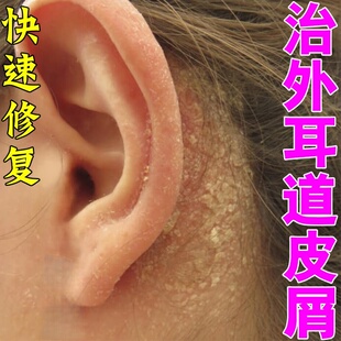 耳朵痒痒外耳道皮屑耳朵流脓痒干燥起皮掉干皮真菌染痒软膏