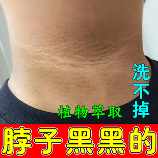脖子黑黑的黑棘皮症脖子色素沉淀脖子洗不干净外用膏