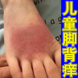 儿童脚面痒脚背反复痒出红疹子干燥脱皮长小水泡真菌染痒膏