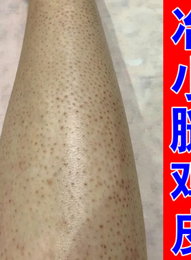 小腿角质长疙瘩修护皮肤嫩滑滋养毛周疙毛囊角化红黑点霜