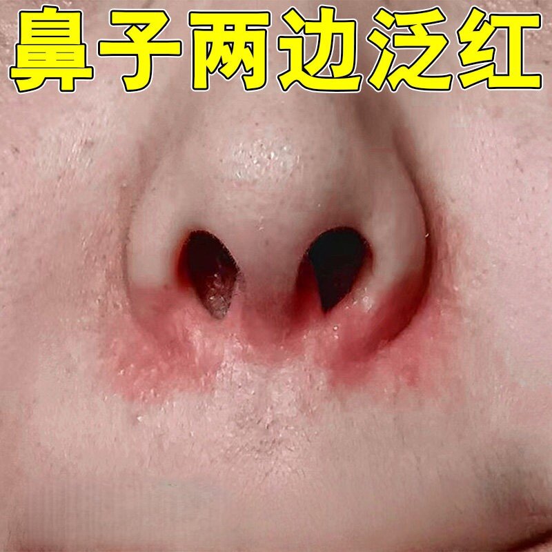 鼻子两侧发红脱皮鼻翼两边泛红起皮脂溢性皮焱酒糟鼻治红鼻头专用