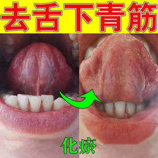 舌下青筋又黑又粗淤血疏通舌头冷黑紫粗大舌头底血管怒张严重喷剂