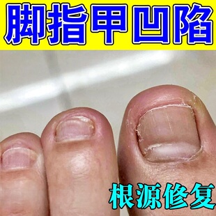 儿童指甲凹凸不平开裂空甲受损甲床分层萎缩坑洼真菌感染增厚坏甲