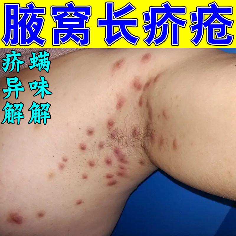 断痒王疥疮膏结节螨虫疥虫阴虱治全身痒长疙瘩水泡疥疮专用膏