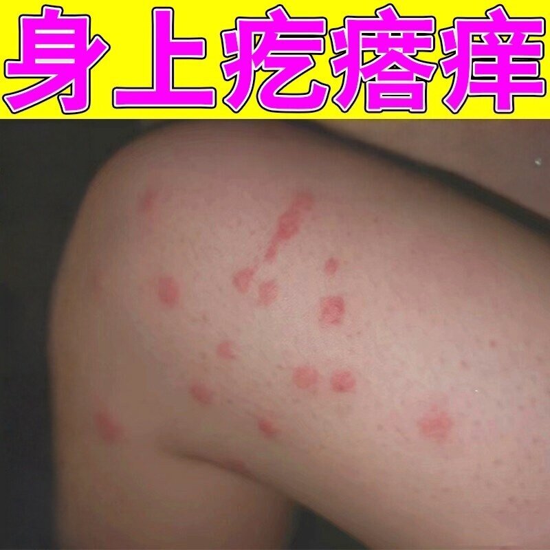 身上起红疙瘩痒皮肤干燥痒长小红点全身起疙瘩痒喷剂