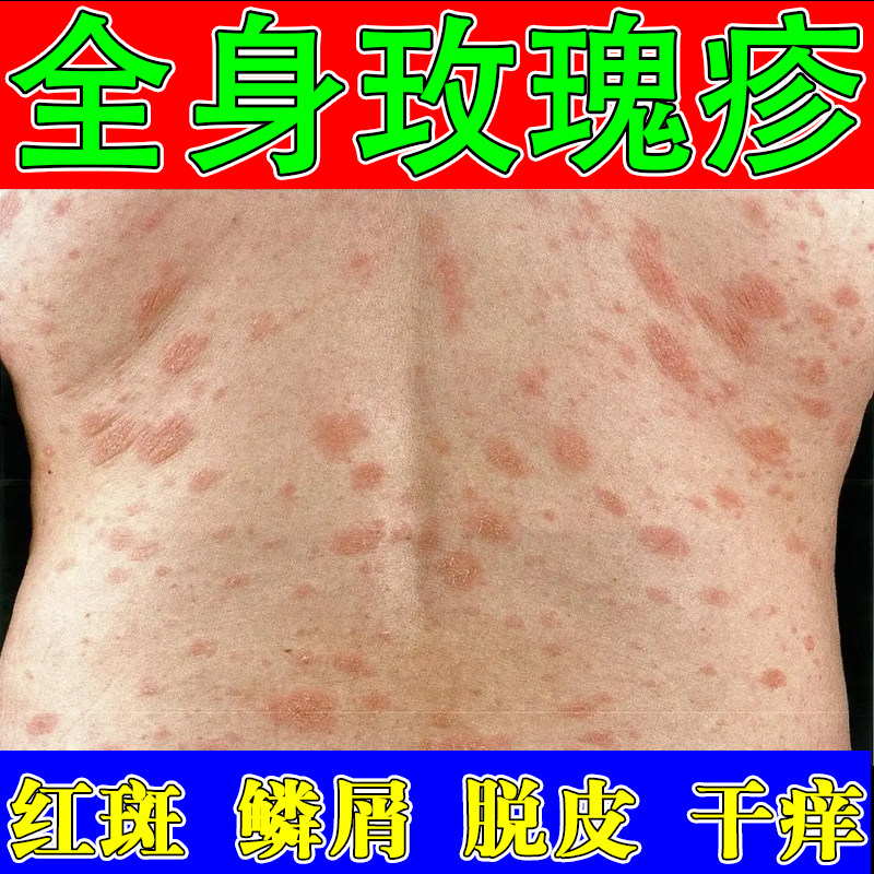 玫瑰花瓣疹专用除膏皮肤过敏痒长红斑鳞屑体想糠疹外用膏