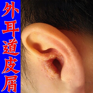 外耳道真菌染耳朵银屑病干燥痒起皮流脓流黄水溃烂痒软膏