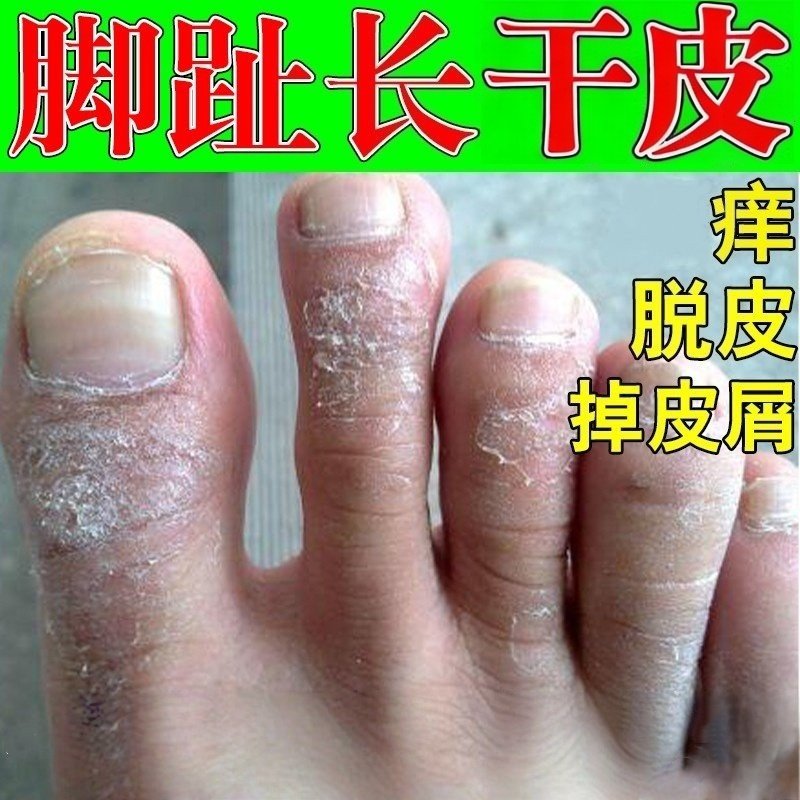 脚趾头上长xian脚趾关节脚背干燥起皮脱皮痒去脚痒膏