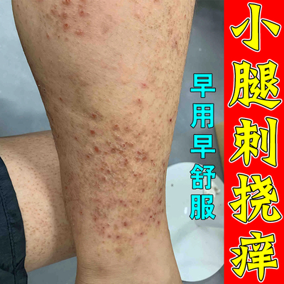 小腿皮肤痒干燥起皮掉皮屑腿部长小红点起红疙瘩剧烈湿痒专用软膏