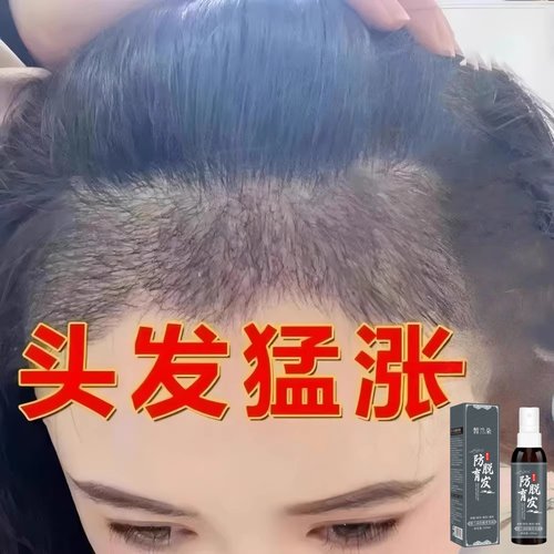 【爆款推荐】头发防脱生长快速增发密发精华液防脱育发男女