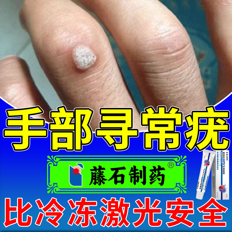 手指头长疣去寻常疣瘊子刺猴子除扁平疣一抹灵神器药监备案XP