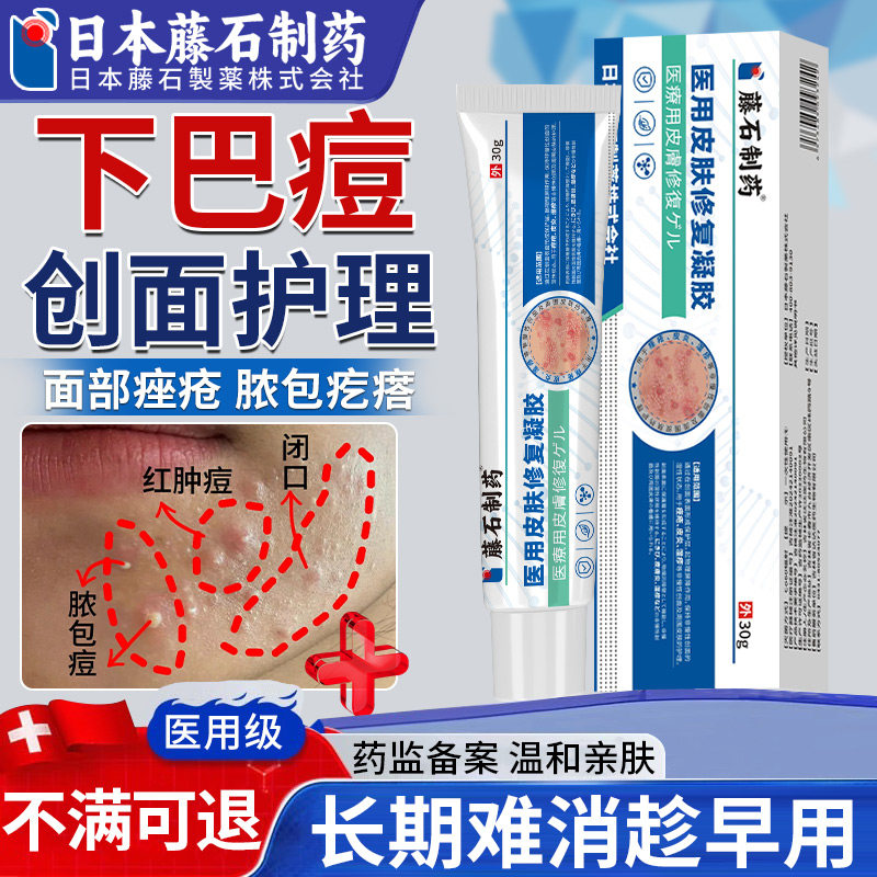 下巴反复长硬块痘痘内调姨妈淋巴痘腮边痘粉刺玫瑰痤疮医用软膏xu