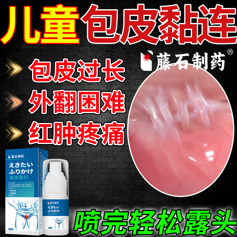 儿童包皮黏连专用外翻器