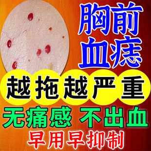 胸前血痣血管瘤血管痣去血痣红痣可搭膏药贴红点蜘蛛痣疣凝胶XP