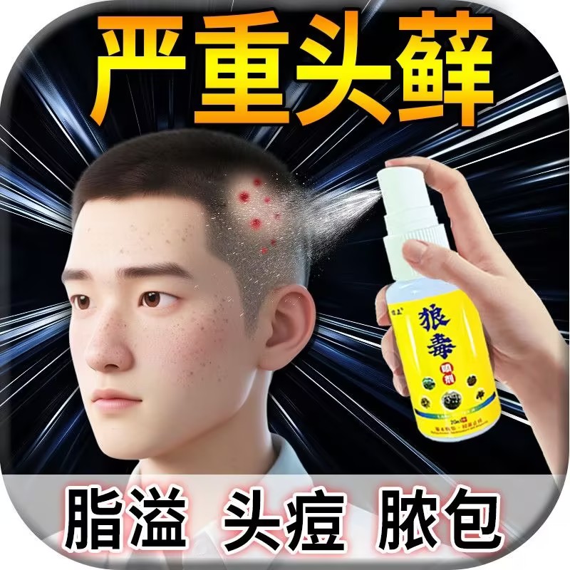 狼毒头藓头皮屑头皮痒头皮发红长疙瘩红斑狼毒喷剂头藓头皮藓