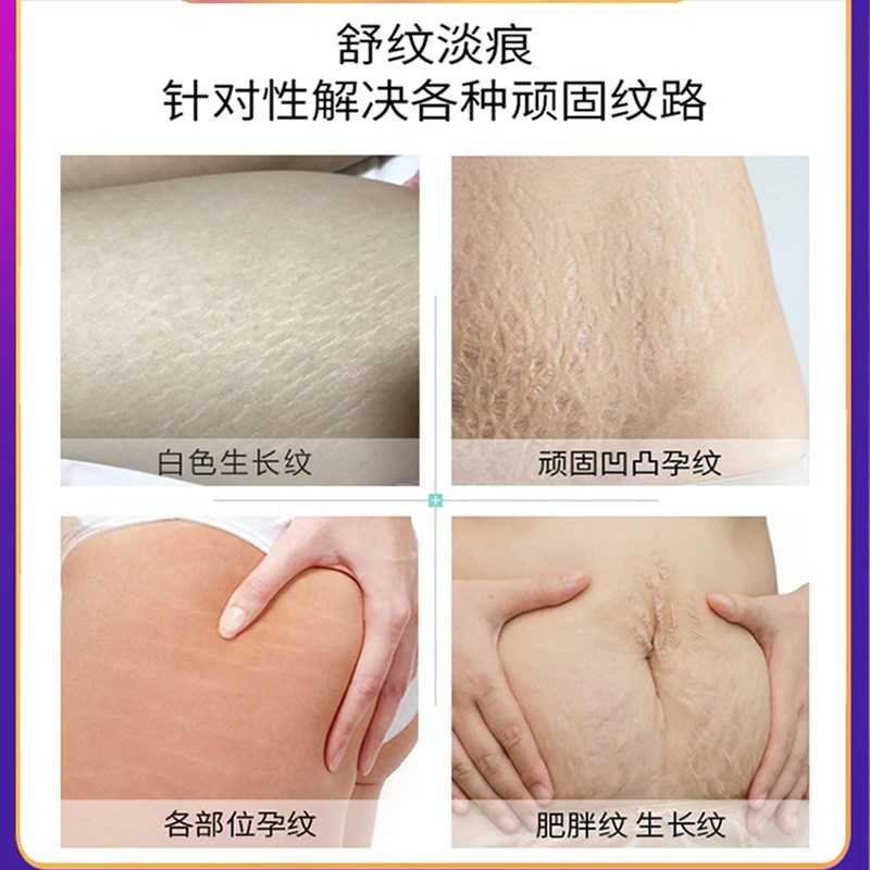 速发肥胖纹去除男福来油去肥胖纹消大腿生长纹妊娠纹产前纹专用修
