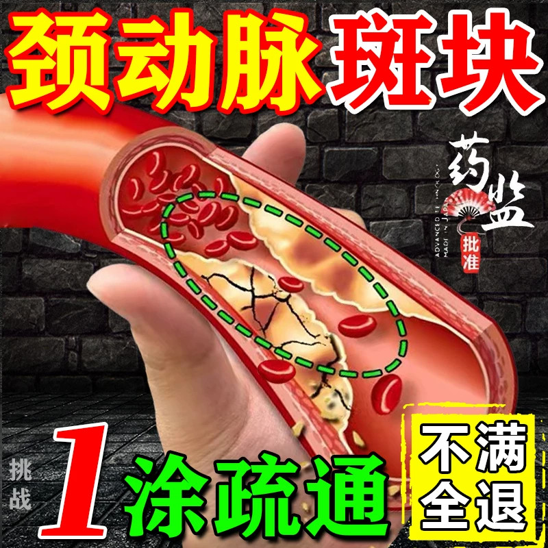 颈动脉斑块消除脑供血不足头晕药
