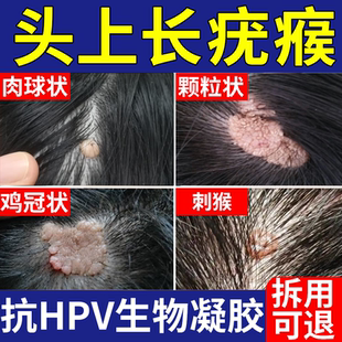 皮脂腺痣头皮寻常疣长刺猴瘊子专外用去药监备案膏贴根点痣去疣VP