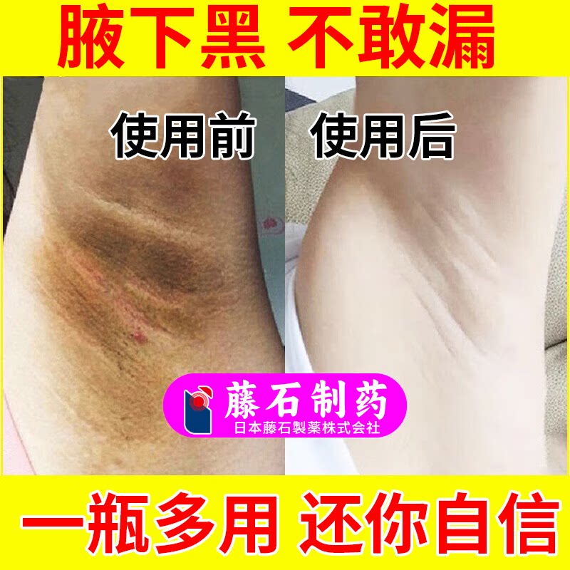 腋下黑黑的黑棘皮症病脖子去黑色素药膏屁股黑色素沉淀洗不净vp