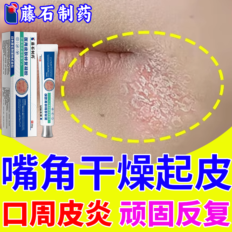 嘴角发红起皮【口周皮炎】医用