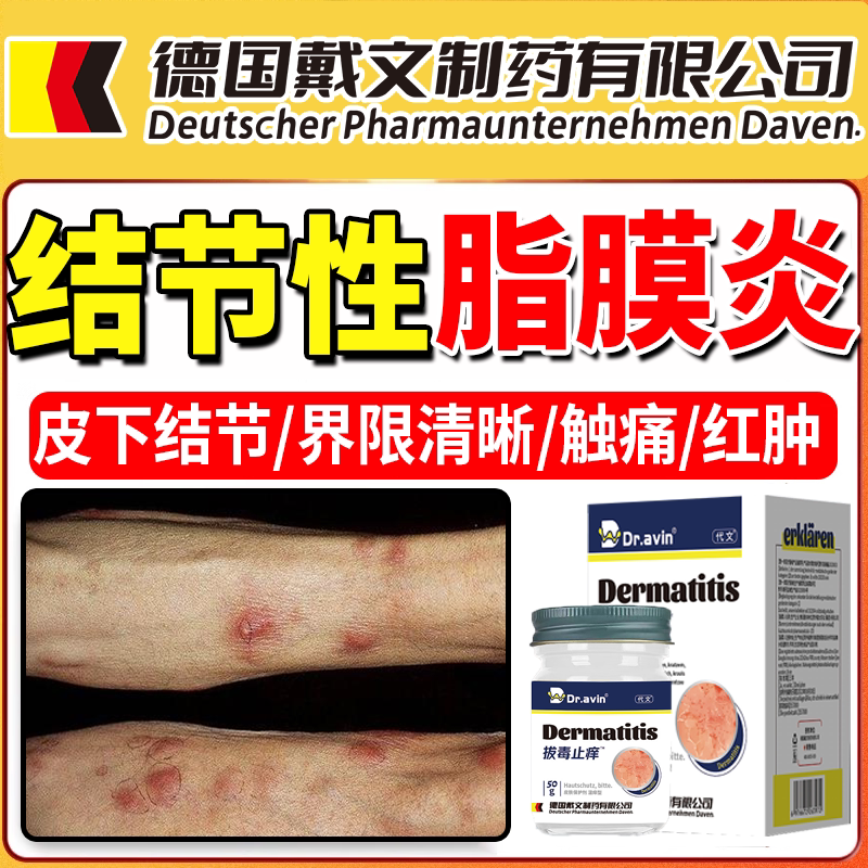 结节性脂膜炎皮下结节专触痛压痛用红热肿胀清晰红斑反复发热vp