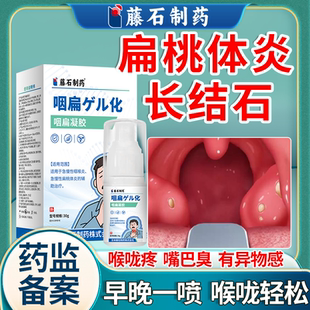 藤石制药扁桃体炎长结石喷剂贴喉咙肿痛口臭异物感吞咽困难疼痛VP