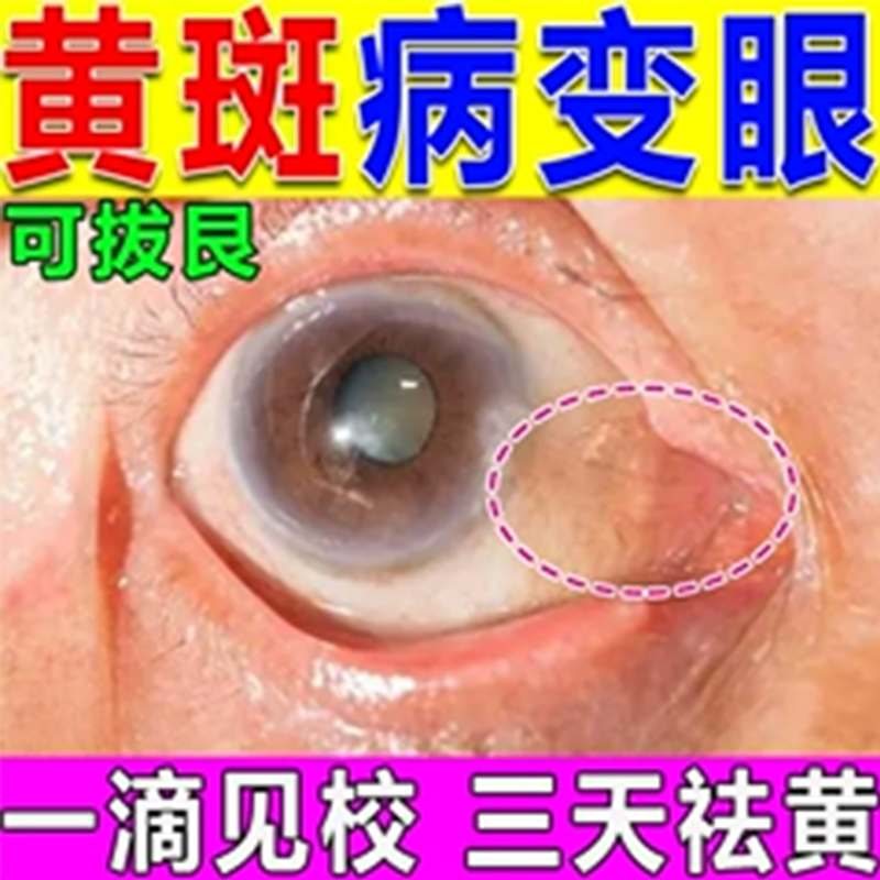 叶黄素精华滴眼液老花眼白内障黄斑病变干眼症状维持视网膜功能