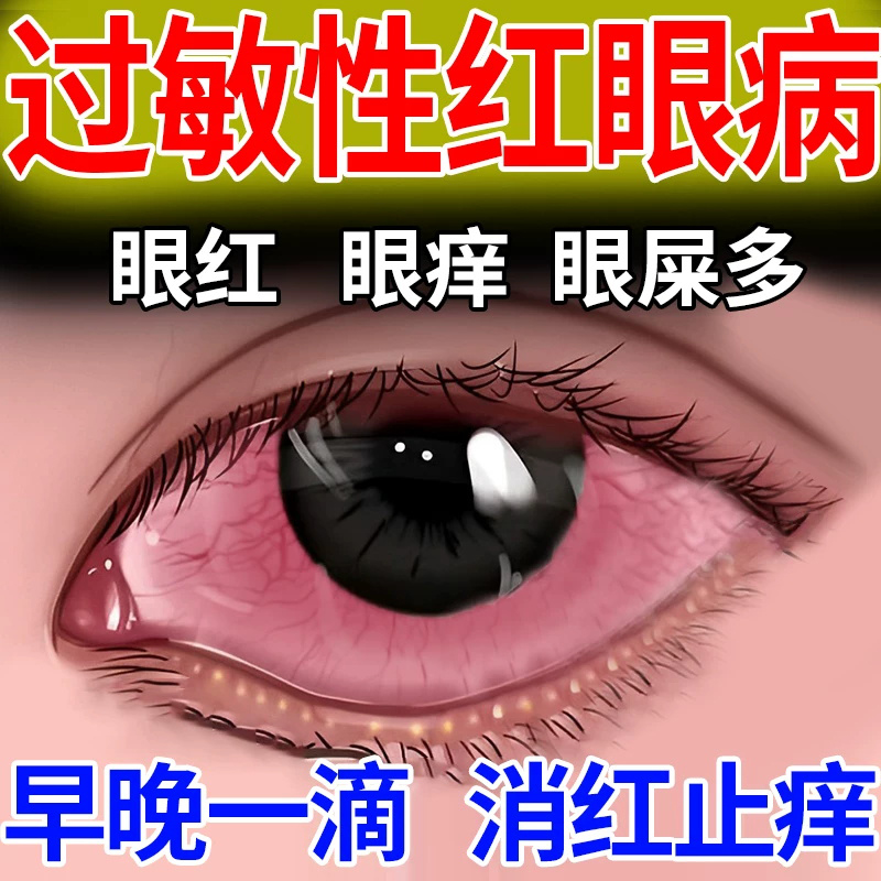 吡嘧司特钾滴眼液过敏性结膜炎春季卡他性结膜炎抗过敏抗血管生成