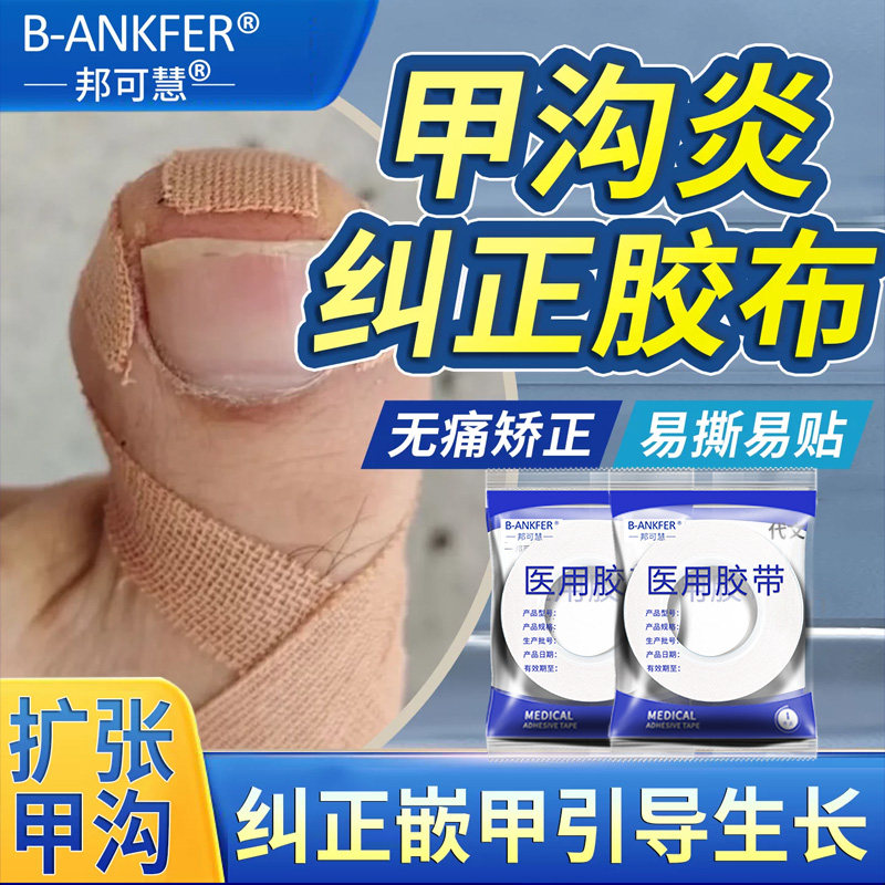 甲沟炎矫正胶带指甲矫正器嵌甲专用隔离脚趾甲长肉里HB