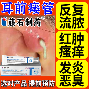 耳瘘耳前瘘管发炎搭配膏药贴清理防水流脓耳仓肿朵消滴耳液儿童OM