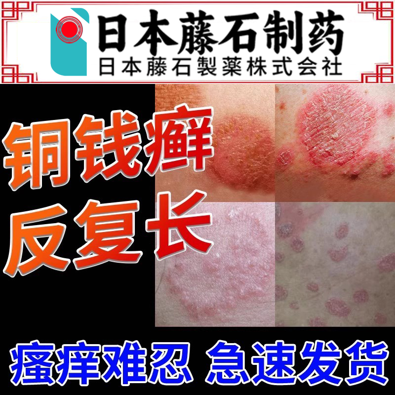 【医院同款】铜钱癣专用