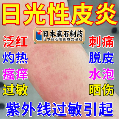 日光性皮炎紫外线过敏修复霜专用止痒膏晒伤瘙痒皮肤荨麻疹喷剂HV