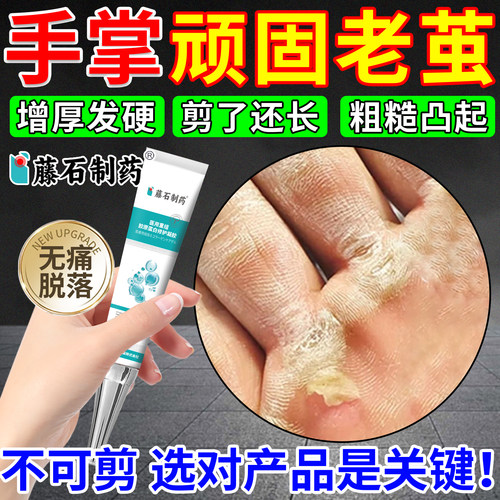藤石制药手茧去手掌长茧硬疙瘩除硬块角质增厚死皮软化膏神器OM