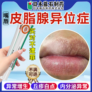 皮脂腺异位症嘴唇起白点脂肪小颗粒唇炎专用疱疹膏搭配药膏贴OM