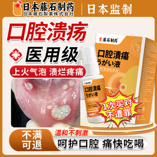 口腔溃疡专用可搭牙膏反复溃疡预防口舌生疮上火起泡除口臭喷剂OM