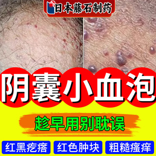 阴囊血管角化瘤阴囊湿疹瘙痒蜘蛛痣红斑血泡疼痛生殖器红色硬块HB