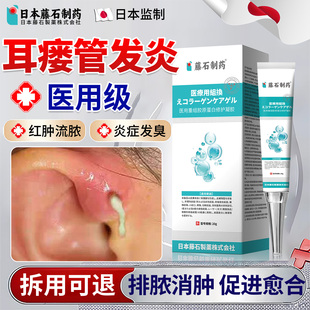 耳瘘耳前瘘管发炎清理防水流脓耳仓肿朵消滴耳液儿童搭配膏药贴OM