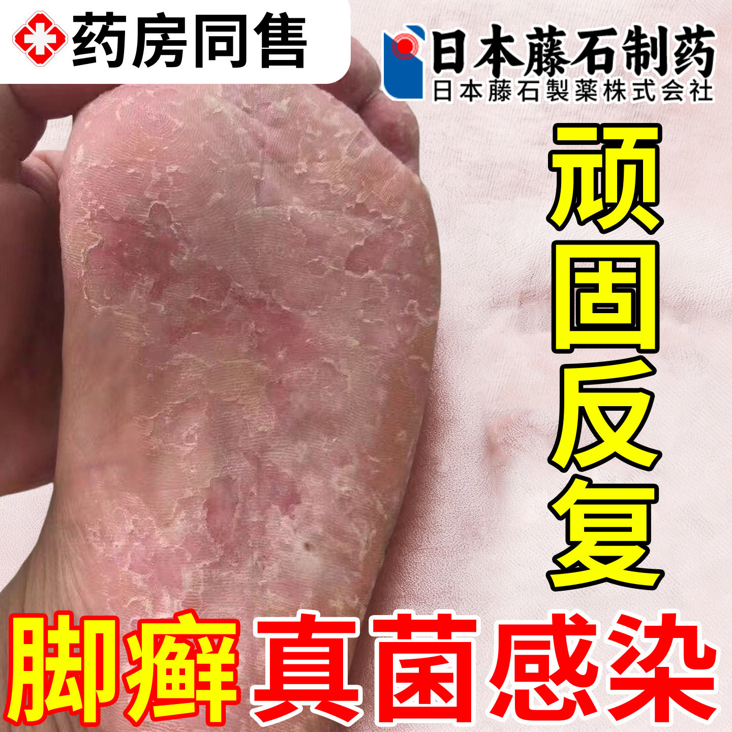 藤石制药角化型足癣脚癣一次净官方旗舰店脚脱皮干裂真菌感染OM